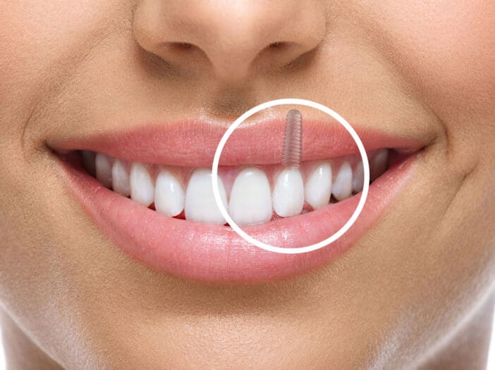 Dental Implants